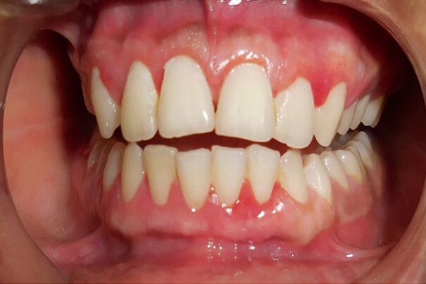 After gingival